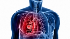 cancer.pulmonar