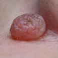 alunita